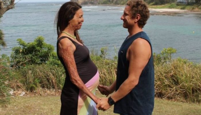 Husband refused to leave his better half after a fire demolished her appearance, showed the importance of genuine love.