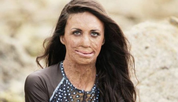 Husband refused to leave his better half after a fire demolished her appearance, showed the importance of genuine love.
