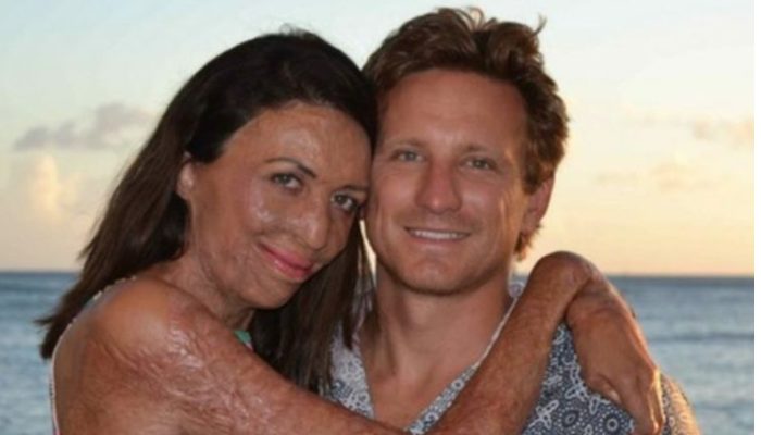 Husband refused to leave his better half after a fire demolished her appearance, showed the importance of genuine love.