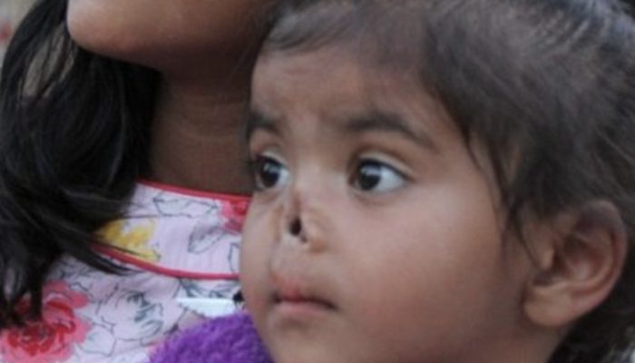 Deserted upon entering the world, this young girl's nose was eaten by insects: However presently she's beginning a new life with her adopted mother in the U.S.