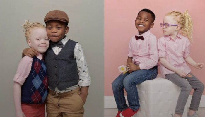 As they grew up, twins with different skin tones became even more distinct from one another.