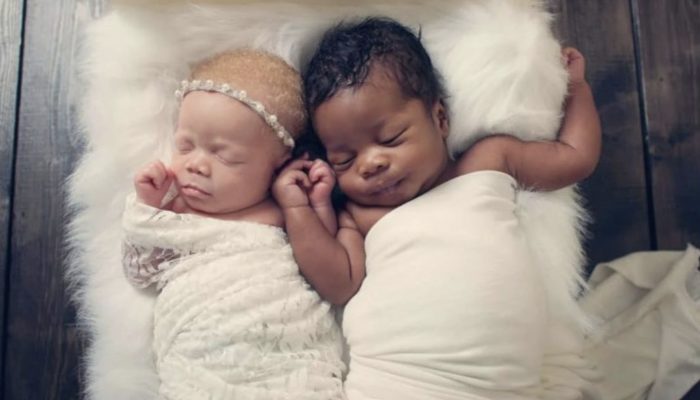 As they grew up, twins with different skin tones became even more distinct from one another.