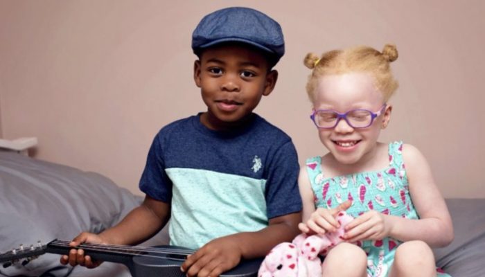 As they grew up, twins with different skin tones became even more distinct from one another.