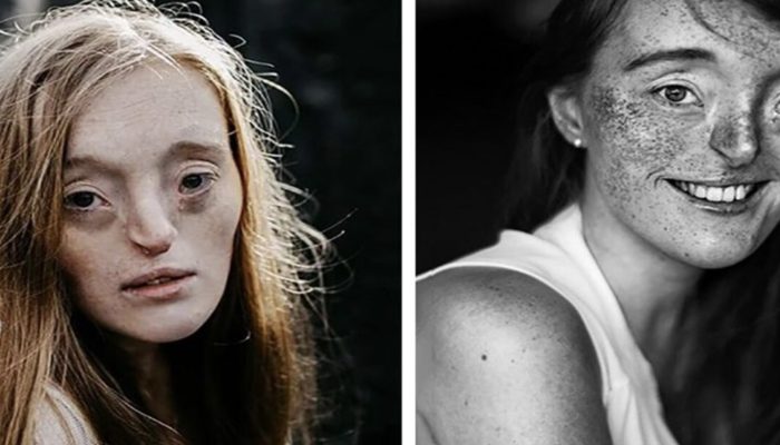 A young girl who was bullied went on to become a supermodel. You will be shocked to see her, definitely.