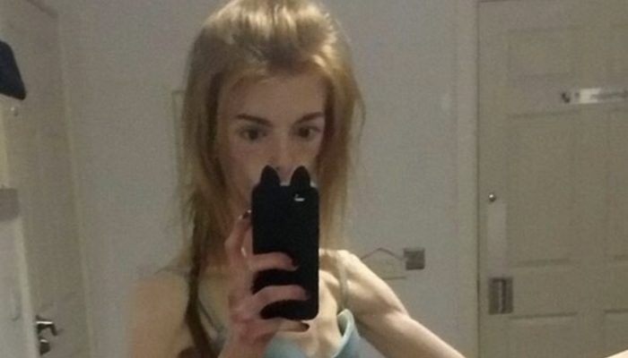 She had anorexia two years earlier and weighed scarcely 29 kg, yet a straightforward chocolate bar assisted her with recuperating!