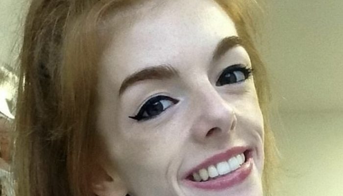 She had anorexia two years earlier and weighed scarcely 29 kg, yet a straightforward chocolate bar assisted her with recuperating!