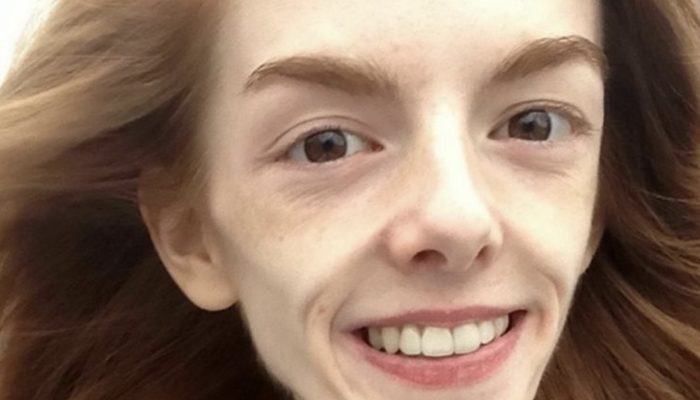 She had anorexia two years earlier and weighed scarcely 29 kg, yet a straightforward chocolate bar assisted her with recuperating!