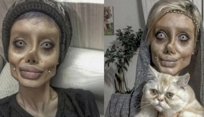 Iranian lady goes through 50 surgeries to seem to be Angelina Jolie and presently she seems to be a zombie.