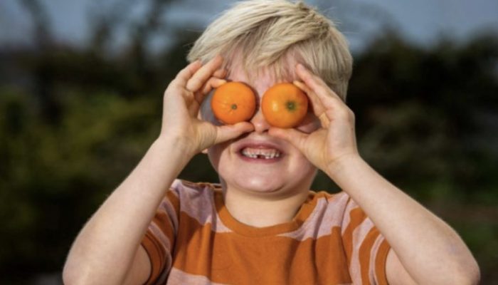 The child had consumed an excessive amount of orange, due to which the color of his face took on a strange hue. Seeing the oranges on his eyes will amaze you.