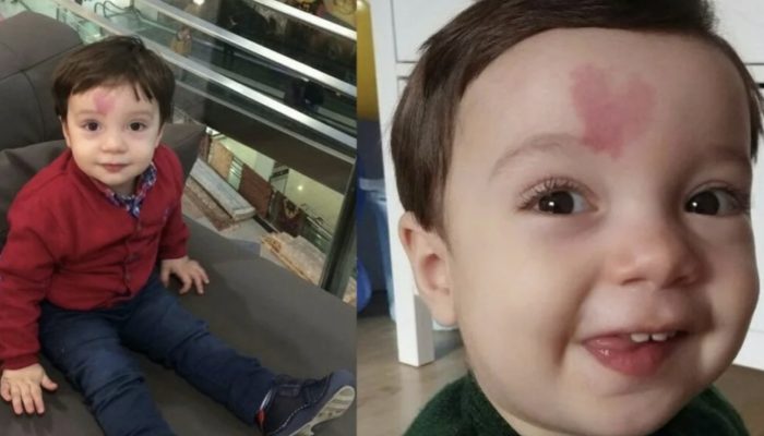 An infant with a birthmark on his forehead in the form of a heart. How does he look at age six?