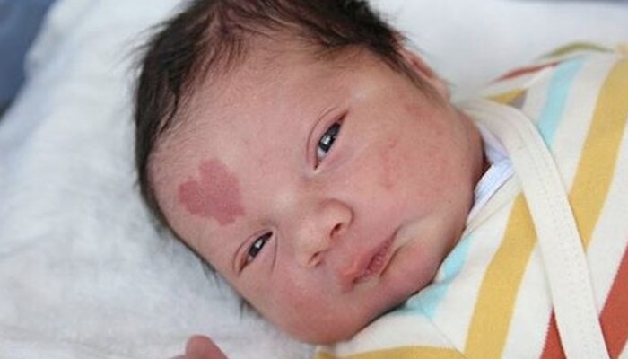 An infant with a birthmark on his forehead in the form of a heart. How does he look at age six?