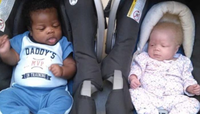What unusual twins look like now and as children. So different, yet so noticeable.