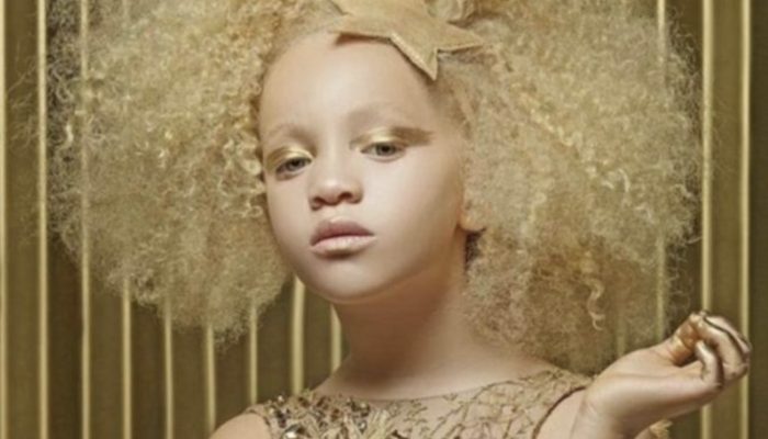 African albino girl has a unique appearance that makes it impossible to ignore how beautiful she is.
