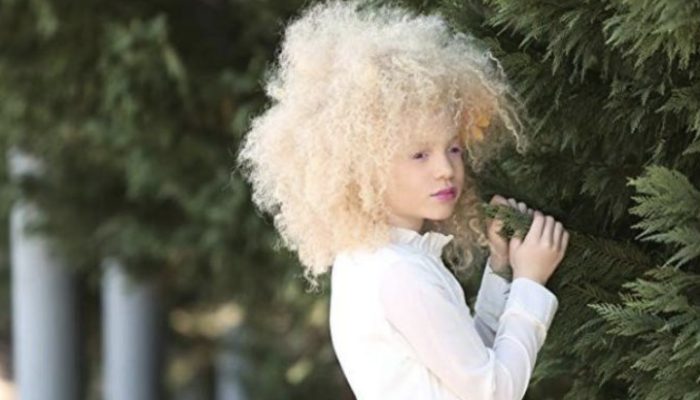 African albino girl has a unique appearance that makes it impossible to ignore how beautiful she is.