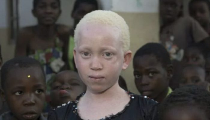 A daughter with an odd appearance was born to a family. Have a look at the girl's appearance now.