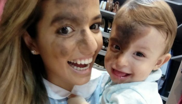 The baby was born with black birthmark and the mother made the same mark to help her baby.