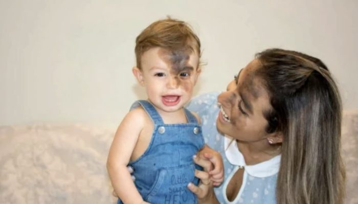 The baby was born with black birthmark and the mother made the same mark to help her baby.