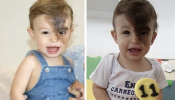 The baby was born with black birthmark and the mother made the same mark to help her baby.