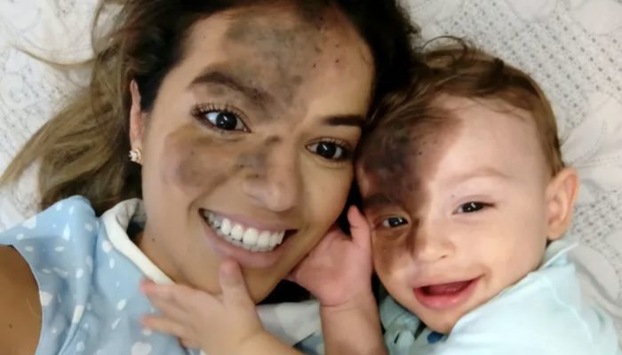 The baby was born with black birthmark and the mother made the same mark to help her baby.