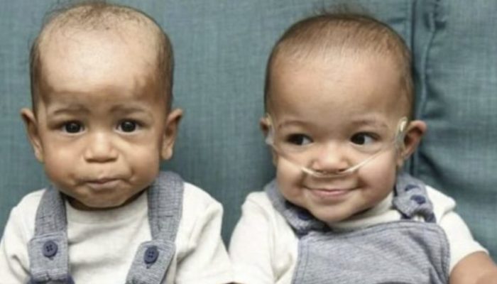The adorable little child saved his twin brother's life. Their story astounded everyone.