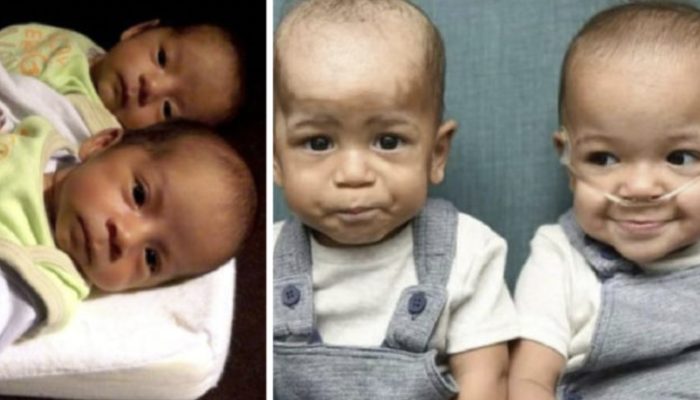 The adorable little child saved his twin brother's life. Their story astounded everyone.