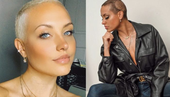 The girl, fed up with hiding her bald patches, shaved her head to demonstrate how beautiful she is without them. The result is unbelievable.