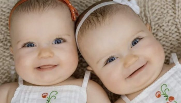 Five years ago, the Siamese twins were successfully separated. Look at how they appear now.