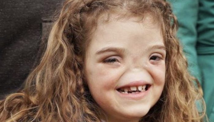 Born extraordinary. See how the girl born without a nose appears today.