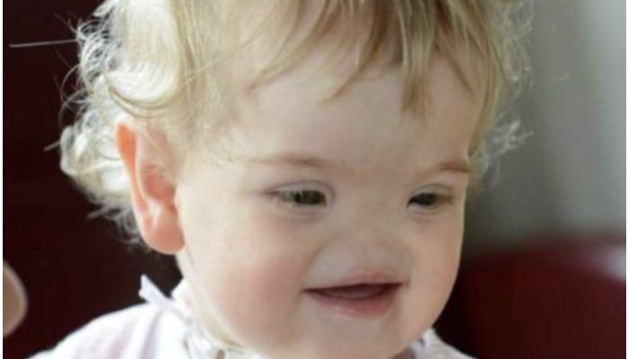 Born extraordinary. See how the girl born without a nose appears today.