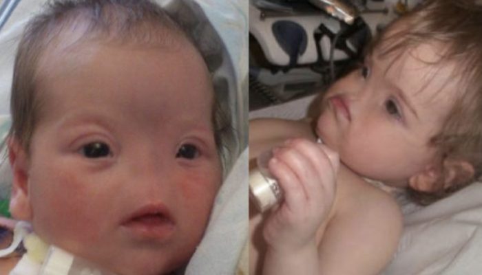 Born extraordinary. See how the girl born without a nose appears today.