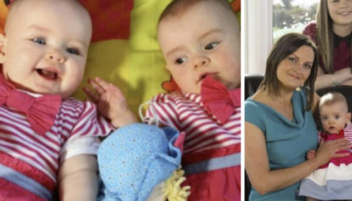 These extraordinary twins are recognized in the Guinness Book of Records. Their story is simply incredible.