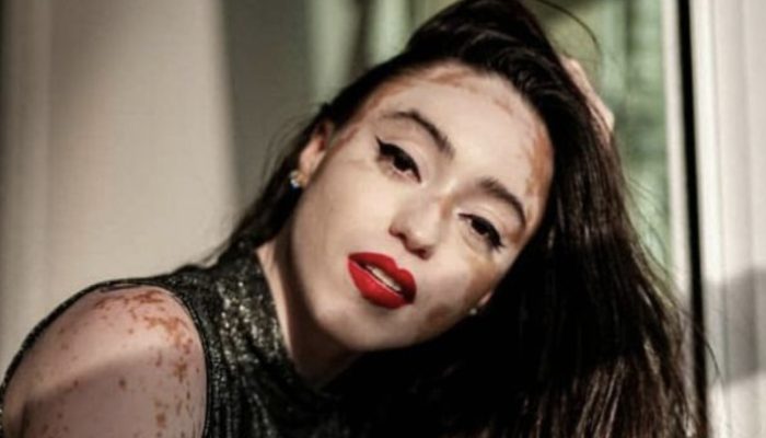 The young woman with the distinctive appearance overcome self-doubt to become a successful model.