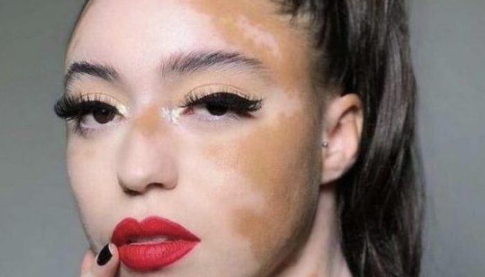 The young woman with the distinctive appearance overcome self-doubt to become a successful model.