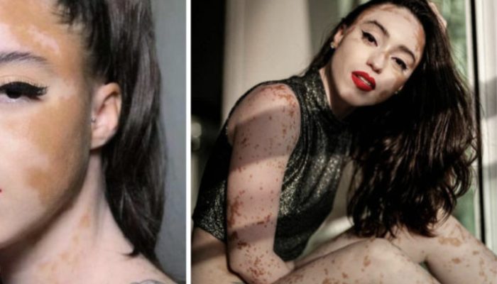 The young woman with the distinctive appearance overcome self-doubt to become a successful model.