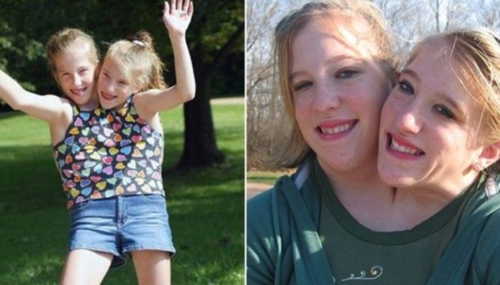 What the most well-known Siamese twins, Brittany and Abigail, now look like.