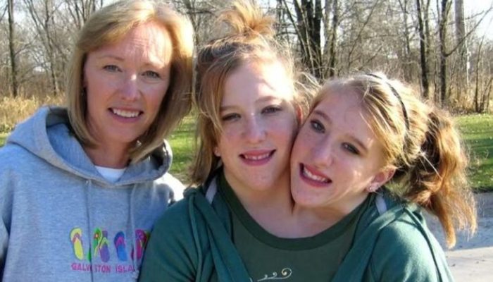 What the most well-known Siamese twins, Brittany and Abigail, now look like.