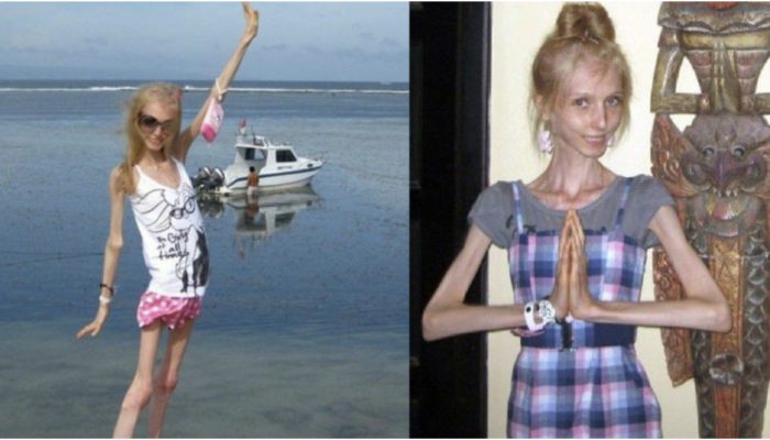The big problems related with being underweight. Discover how a girl weighing only 23 kg transformed.