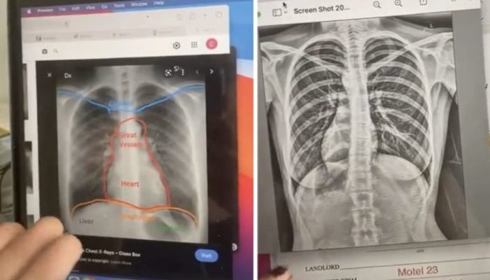 The girl had an x-ray and discovered that persons like her are less than 1% of the world's population.