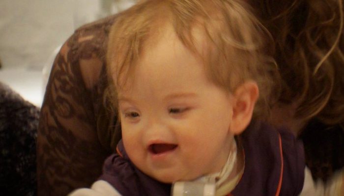 Tell us about the child's life now that she is eight years old and has lived without a nose from birth