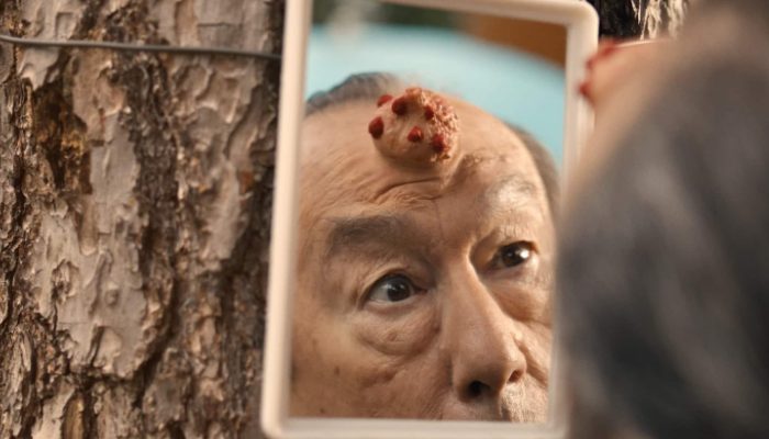 Learn more about Philou, the world's first man to have a prostate on his forehead