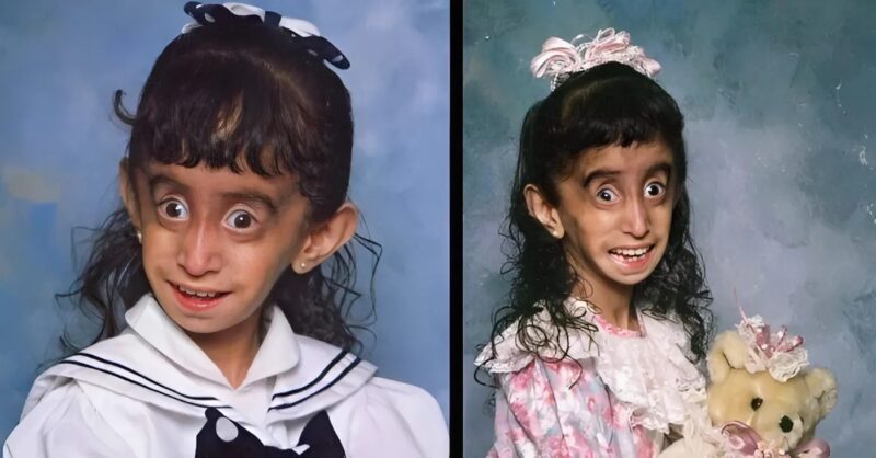 A világ ‘legcsúnyább’ lányának története – tegnap és ma! Lizzie Velasquez inspiráló élete bizonyítja, hogy az igazi szépség túlmutat a külsőségeken. Egykor gúnyolták, ma milliókat motivál erejével és önelfogadásról szóló üzenetével.