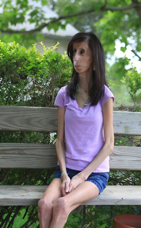 A világ ‘legcsúnyább’ lányának története – tegnap és ma! Lizzie Velasquez inspiráló élete bizonyítja, hogy az igazi szépség túlmutat a külsőségeken. Egykor gúnyolták, ma milliókat motivál erejével és önelfogadásról szóló üzenetével.