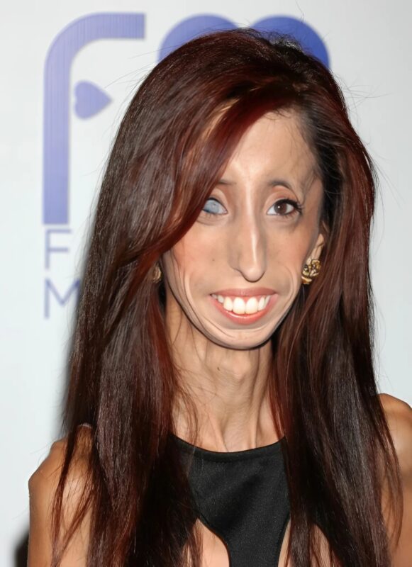 A világ ‘legcsúnyább’ lányának története – tegnap és ma! Lizzie Velasquez inspiráló élete bizonyítja, hogy az igazi szépség túlmutat a külsőségeken. Egykor gúnyolták, ma milliókat motivál erejével és önelfogadásról szóló üzenetével.