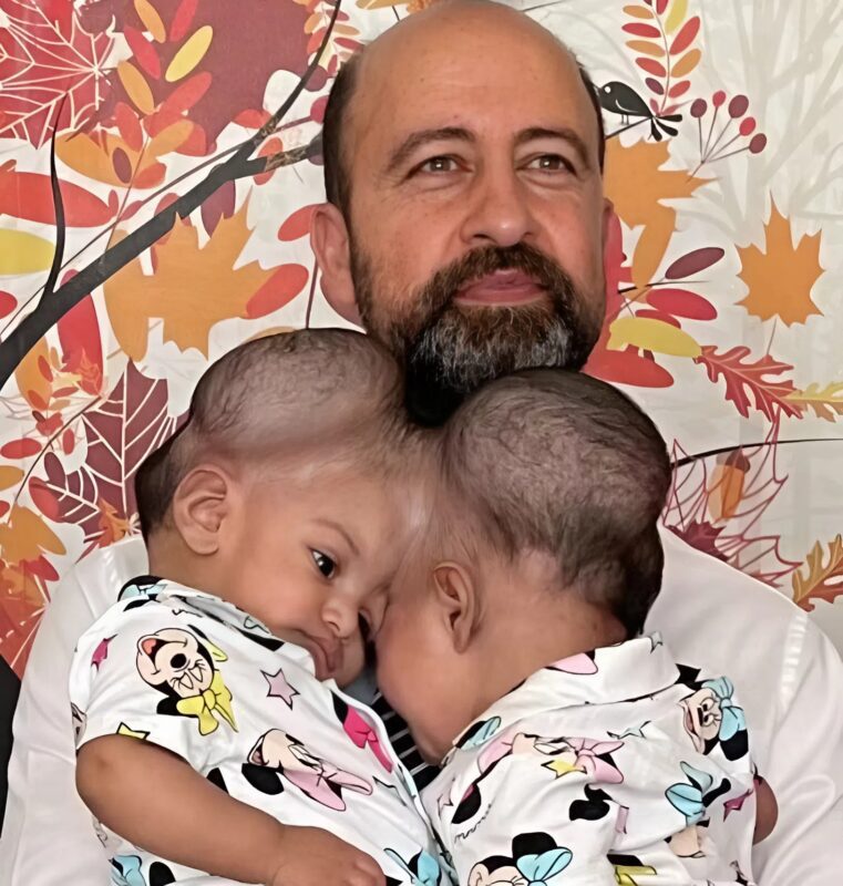 A lánytestvérek egy fejjel születtek, de amikor 3 évesek voltak, az orvosok szétválasztották őket. Így néznek ki ma.