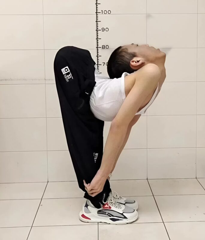 Egy szokatlan állapotú fiút műtöttek – el sem hiszed, hogy néz ki ma.