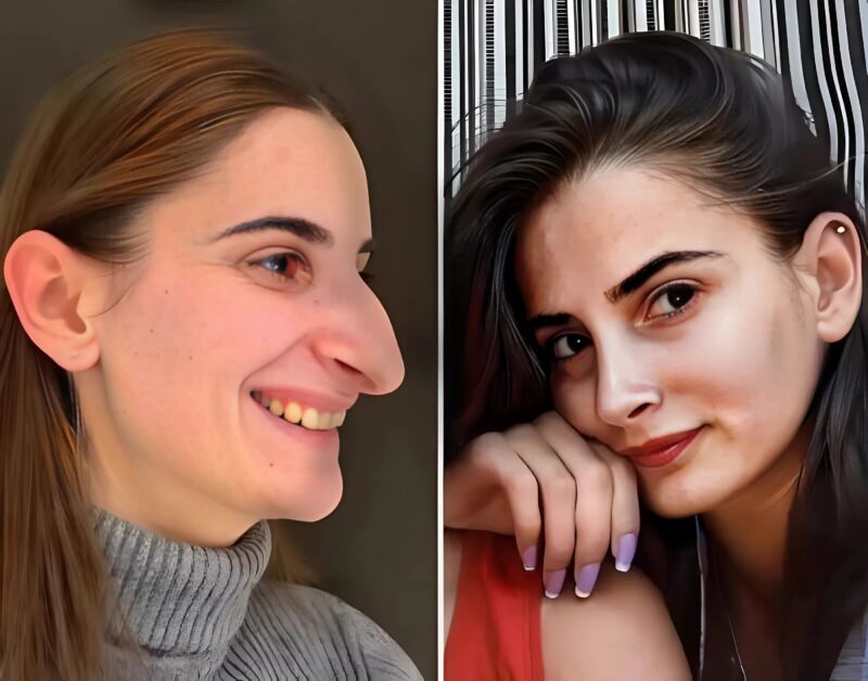 Egy szokatlan orrú lány plasztikai műtéten esett át: így néz ki 6 hónappal a változások után.
