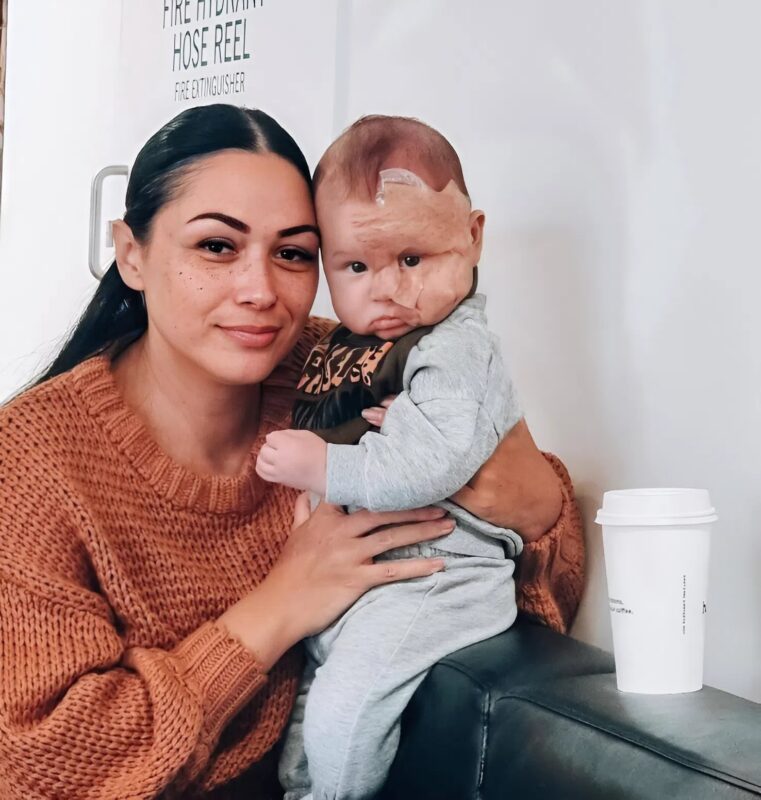 Egy anya szörnyetegnek nevezte újszülött fiát, amiért lézerterápiával távolították el az anyajegyét, és íme, mi történt ezután.
