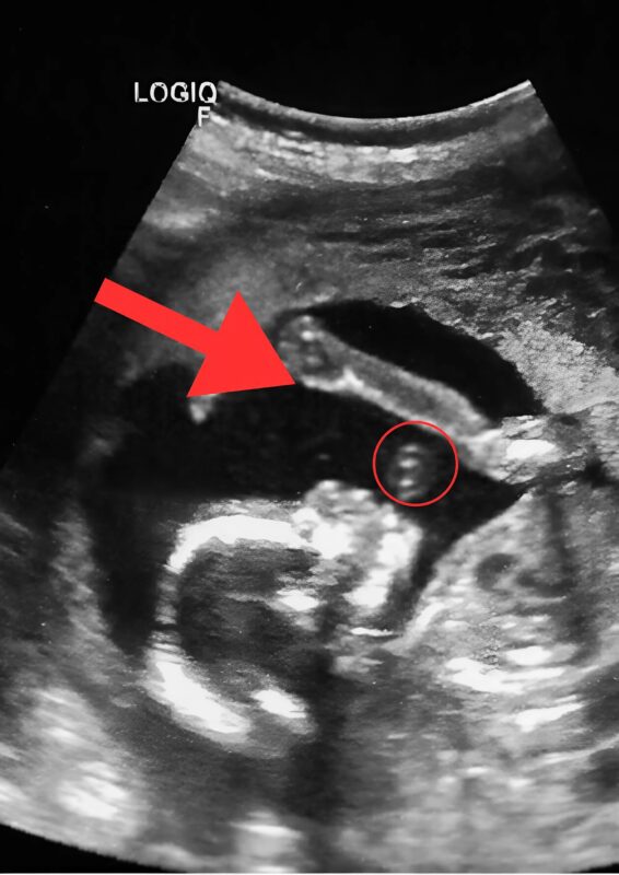 Az ultrahangvizsgálat során az orvos hirtelen megállt, tanulmányozta az arckifejezésemet, és meglepetten közölte, hogy az eredmények teljesen váratlanok, egy pillanat alatt megváltoztatva az egész látogatás értelmét.