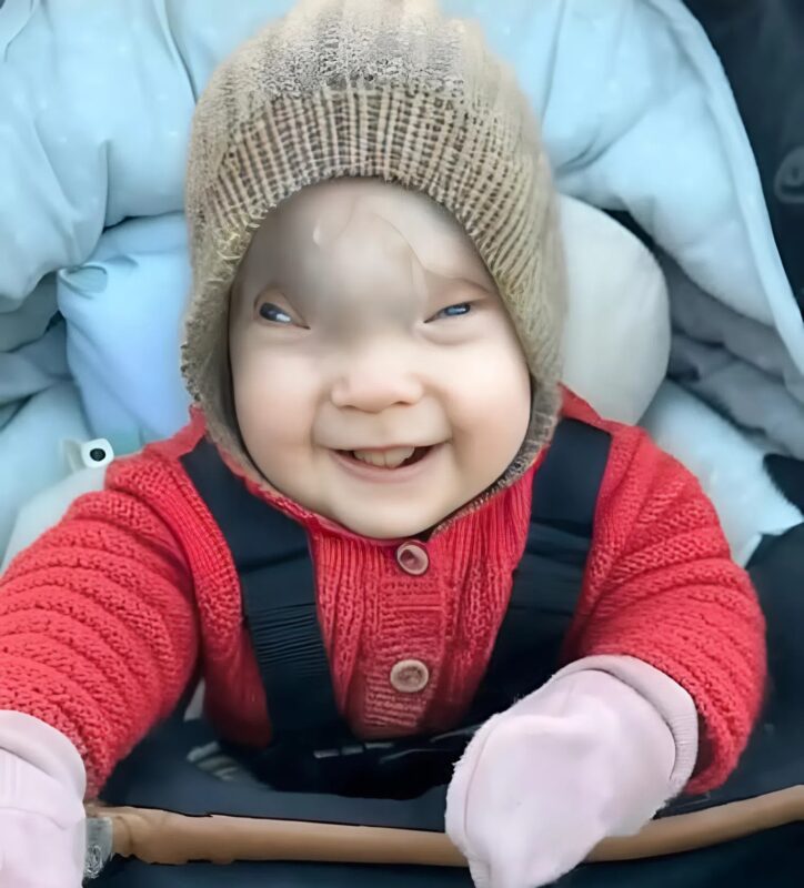 Egy ritka arcbőrbetegséggel születtem, így nézek ki 18 évvel később, meglepődsz majd, ahogy mindenki más is.