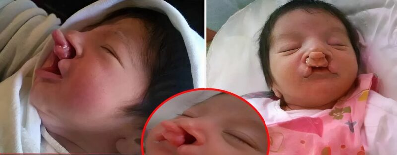 Egy vlorai kisfiú ritka szindrómával született, számos műtéten esett át, így néz ki 5 évesen.